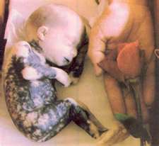 Saline abortion